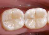 gelockerten Zähnen Facettenreparaturen, Reparatur von Schmelzdefekten und provisorischen K&B-Materialien Erweiterte Fissurenversiegelung Restauration von Milchzähnen Stumpfaufbau Composite-Inlays Das