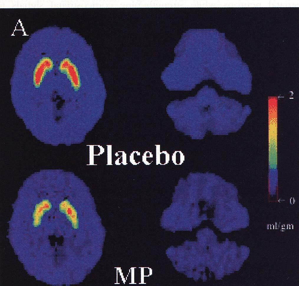 Darstellung der Wirkung von MPD im Gehirn Ausgangspunkt: Erhöhung des Dopamintransporters (mittlerweile fraglich als ätiologischer Mechanismus) Darstellung der Verminderung der Rezeptorverfügbarkeit