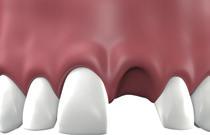 SIEHT MAN NACHHER EINEN UNTERSCHIED? Situation nach Zahnverlust Ästhetisch perfekter Verschluss der Zahnlücke KANN MEIN ZAHNARZT MIR BEI FRAGEN WEITERHELFEN?