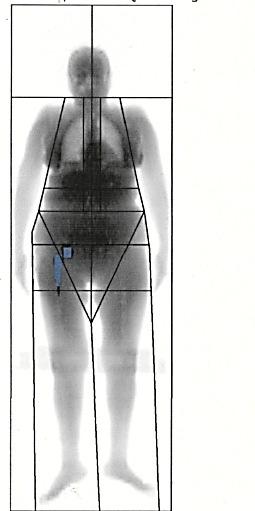 Muskelmasse Cut-Offs für Sarkopenie EWGSOP IWGS FNIH 5,67kg / m 2 5,67kg / m 2 < 0,512 / (kg / m 2 ) 7,23 kg / m 2 7,23 kg / m 2 < 0,789 /