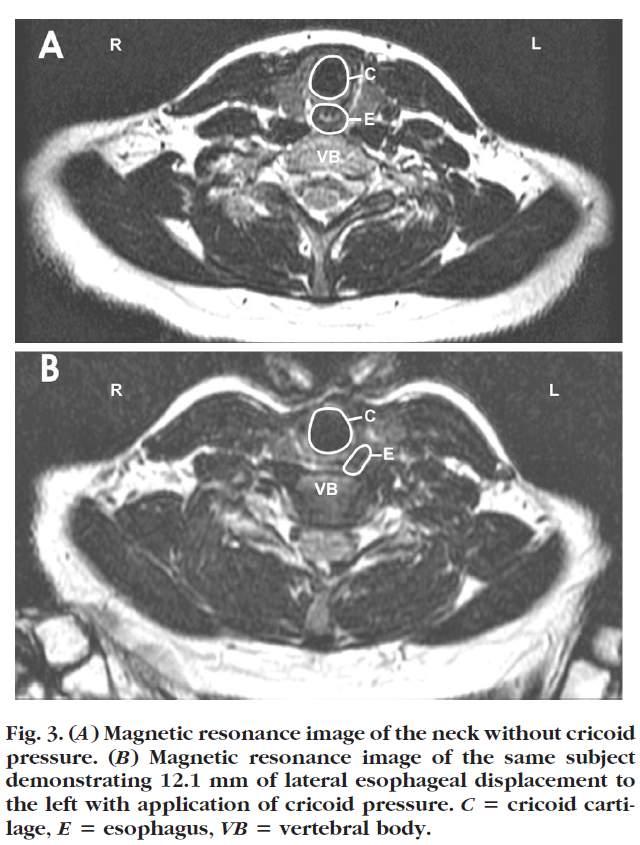 Laterale Larynxverlagerung durch KD bei 66,7% Sellicks Schlussfolgerung: KD verhindert die Regurgitation während der Anästhesie-Einleitung