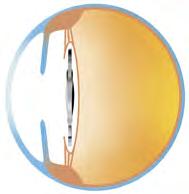 WAS IST DER GRAUE STAR? Der Graue Star (Katarakt) ist eine Trübung der natürlichen Augenlinse, die in der Regel ab dem 60. Lebensjahr auftritt.