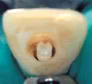 rate of endodontically treated maxillary incisors with approximal