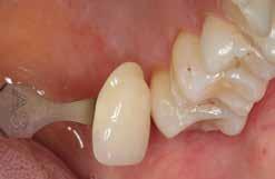 Farbnahme Farbnahme am natürlichen Zahn Nach der Zahnreinigung erfolgt die Bestimmung der Zahnfarbe mittels Farbschlüssel am noch nicht präparierten Zahn bzw. den Nachbarzähnen.