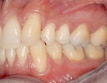 Antiinfektiöse Therapie Nach abgeschlossener Diagnostik und Schienung von Zahn 15 begann
