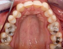 individuelle Mundhygiene des Patienten optimiert wurde, individuelle