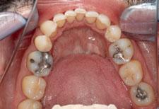 Da ein weiterer Attachment- und Zahnverlust bei Recallpatienten eher selten vorkommt, ist es vertretbar auch weiterhin zu versuchen, den erreichten Zustand möglichst lange zu konservieren 7,9. Sens.