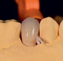 kann bei parodontal vorgeschädigten Pfeilerzähnen oftmals eine sekundäre Verblockung durch fortlaufende Klammern empfehlenswert sein.