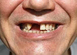 Zahngesundheit Bei Verlust eines Zahnes im Laufe der letzten 2 Jahre: Um Faktor 1,45 erhöhtes Glaukomrisiko Bei