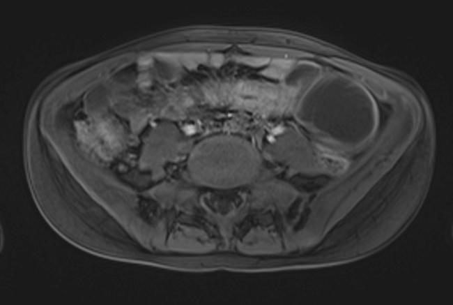 Entzündungsprozesses (Pfeile). Der betroffene Darmabschnitt stellt sich im diffusionsgewichteten Bild mit einem b-wert von 800 s/mm² (c) signalreich und in der ADC-Map (d) hypointens dar (Pfeile). 3.