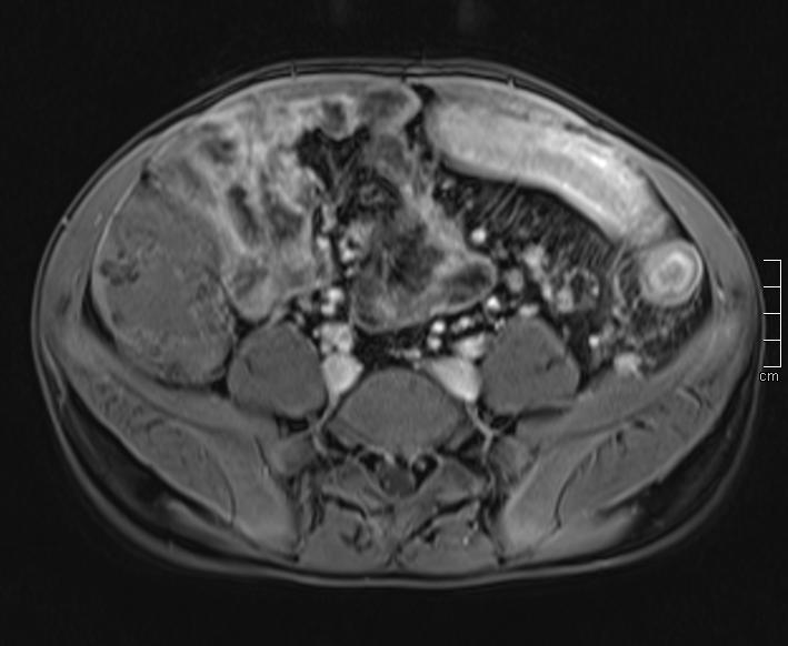 Abbildung 4: Transversales, kontrastverstärktes T1w-Bild eines 18-jährigen Patienten mit akut entzündlichen Darmwandveränderungen des Colon transversums, des Colon descendens und des Rektosigmoids.