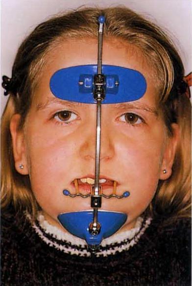 Die Behandlung mit der sogenannten orthopädischen Gesichtsmaske wurde im Jahre 1971 erstmals von Jean Delaire beschrieben [3-5].