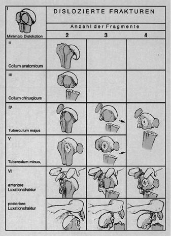 11 Abbildung 3 Abbildung 3 Frakturklassifikation nach Neer aus (Ruchholtz and Nast-Kolb 2003) Als Kriterium für eine Dislokation gilt die Verschiebung von einem der Hauptfragmente - Humeruskopf,