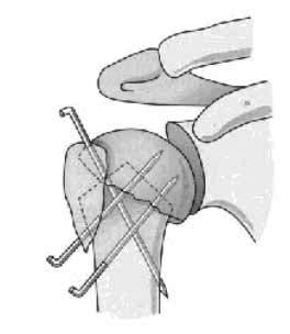Zusätzlich können die Tubercula entweder mit einer achtförmigen Drahtzerklage (s.unten) oder einer entsprechenden Fadenschlinge zusätzlich fixiert werden.
