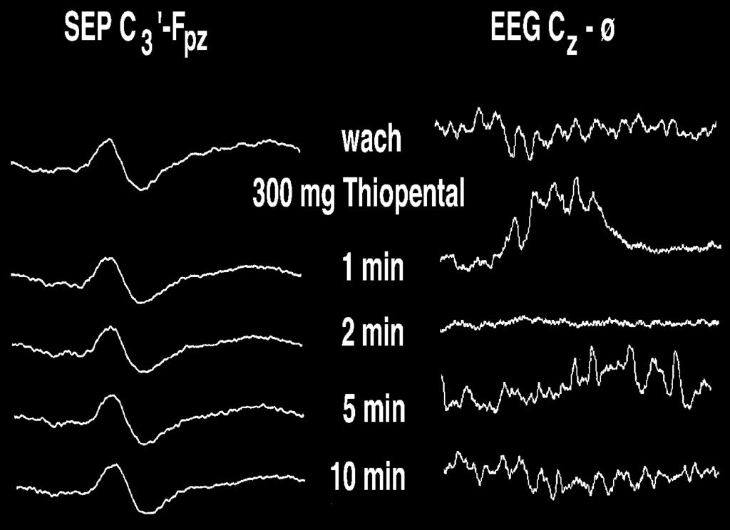 EEG und SEP: Einflüsse Hypoglykämie Hämodilution Hypo-/Hyperkapnie Hypothermie Anästhetika zerebrale Ischämie Medianus-SSEP Nativ-EEG