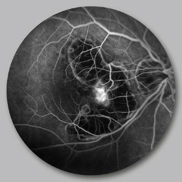 Fluoreszenzangiografische Aufnahme eines gesunden Auges Fluoreszenzangiografische Aufnahme einer mcnv Bei Fällen von