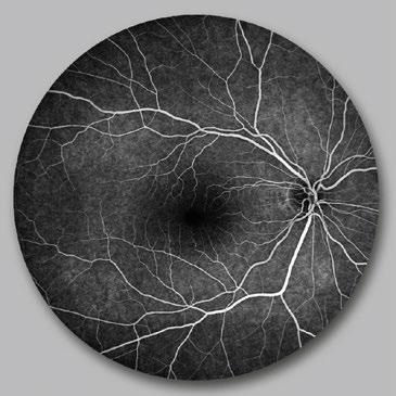 Etwa 10 Prozent der Patienten mit pathologischer Myopie entwickeln diese Komplikation.