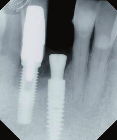 Damit wird zum Beispiel auch das erhöhte Periimplantitisrisiko bei Patienten erklärt, die schon ihre natürlichen Zähne durch Parodontopathien verloren haben [31, 33].