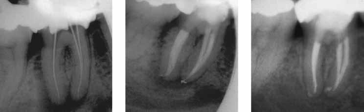 Inhalte, Aufgaben und Ziele der Endodontie 1 EINFÜHRUNG Definition: Endodontie ist der Teilbereich der Zahnheilkunde, der sich mit der Anatomie, Histologie und Physiologie des Endodontiums und mit