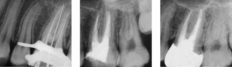 2): Vitalerhaltung der Pulpa (falls möglich) langfristige Erhaltung eines Zahns mit irreversibel geschädigter Pulpa als voll funktionsfähige Kaueinheit Vermeiden der Schädigung oder Erkrankung von
