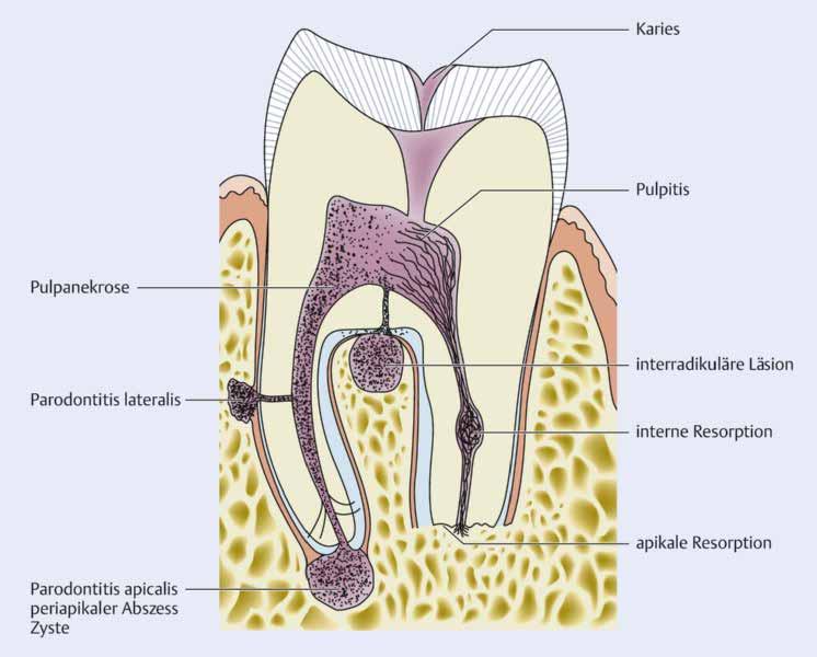 1 EINFÜHRUNG Erkrankungen des Endodonts und des apikalen Parodonts Abb. 1.3 Erkrankungen des Endodonts und der periradikulären Gewebe.
