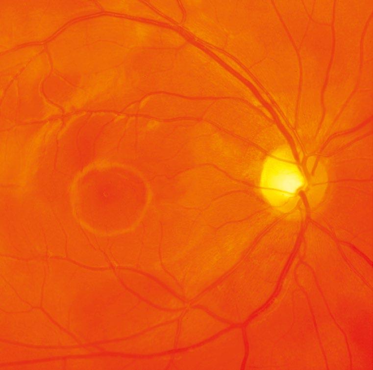 Blutgefäße Makula Sehnervenkopf (Papille) Blick auf den Augenhintergrund Betrachtet man sich das Auge bei einer augenärztlichen Untersuchung von innen, so wirkt die Makula ein wenig dunkler als die