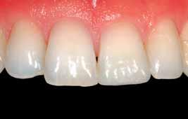 Die Holzkeile fixieren die Matrizen und sorgen durch Verdrängung der Zähne für die Kompensation der Matrizenstärken, um ausreichend stramme Kontaktpunkte zu erhalten.