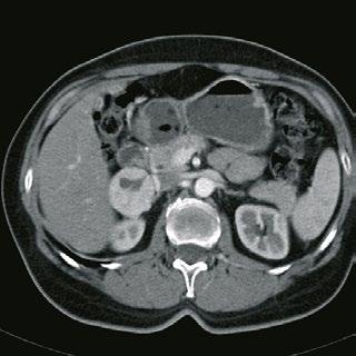 Das linke (Bild 1) CT des Bauchraums wurde ohne Kontrastmittel aufgenommen, das CT auf der rechten Seite (Bild 2) mit