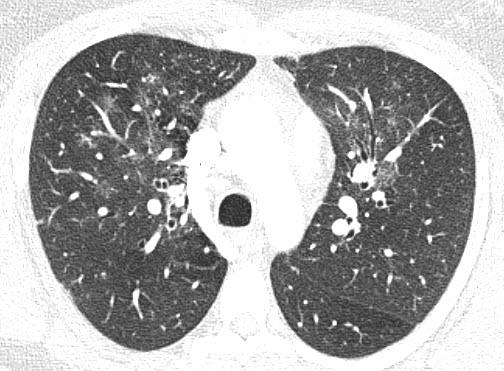 Status ((Ü3)) 33-jährige Patientin, BMI 33 kg/m 2. BD 117/80 mmhg, Puls 84/min. SpO2 98% an Raumluft. <1 cm indolente palpable Lymphknoten bds. submandibulär. Kardiopulmonal, Abdomen und Haut: bland.