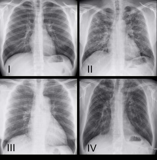 Abb. 1: Radiologische Stadien der Sarkoidose (nach Scadding): I: Bilaterale hiläre Lymphadenopathie (BHL). II: BHL und pulmonale Noduli. III: Pulmonale Noduli ohne BHL.