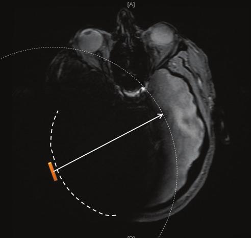 Risiken im Zusammenhang mit MRT und Cochlear Nucleus Implantaten Bildstörungen und -artefakte Das Nucleus Implantat von Cochlear verursacht um das Implantat herum Verschattungen auf dem