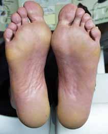 1.3 Ursachen und Symptome Der Diabetes-Fuß ist auf zwei Folgeerkrankungen eines langjährigen Diabetes mellitus zurückzuführen: die Polyneuropathie (PNP) eine Nervenschädigung und die periphere