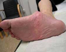 1.3.4 Sonderfall "Charcot-Fuß" Die genaue Bezeichnung dieser besonders gravierenden Form des Diabetes- Fußes lautet "diabetisch-neuropathische-osteoarthropathie", kurz: DNOAP.