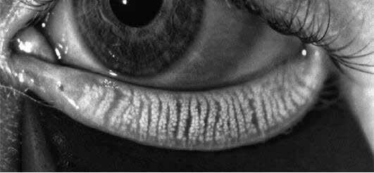 UNTERSUCHUNGEN MIT LIPIVIEW INTERFEROMETRIE Die sogenannte Augenvorderabschnittsinterferometrie ist ein spezielles Bildgebungsverfahren