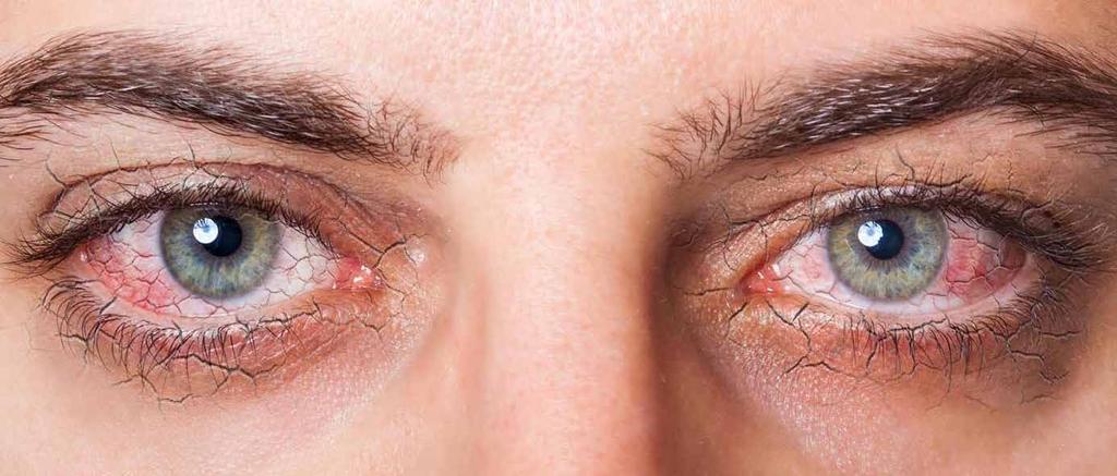 DIE SYMPTOME Das gesunde Auge ist immer von einem geschlossenen Tränenfilm überzogen. Er hält es feucht und macht es weniger empfindlich gegenüber Umwelteinflüssen wie Keimen oder Fremdkörpern.