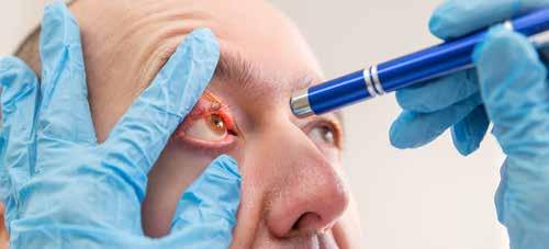 TRÄNENDE AUGEN BLENDEMPFINDLICHKEIT Sogar tränende Augen können ein Symptom der trockenen Augen sein.