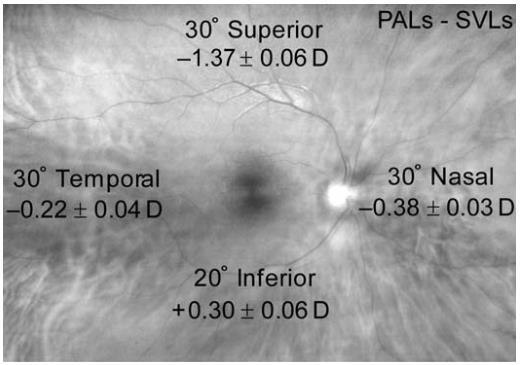 Retinaler Defocus mit PAL