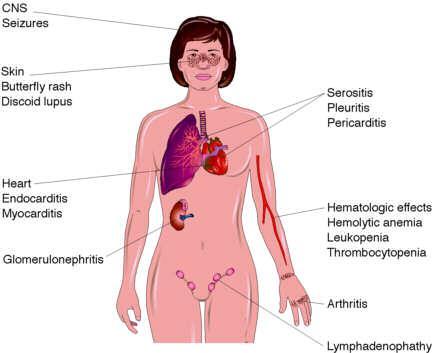 Systemischer Lupus