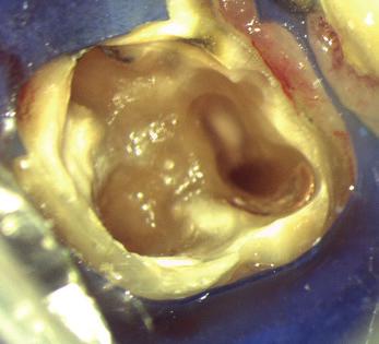 Auf der 3-Monats-Kontrollaufnahme (Abb. 6) ist ein gleichmäßig durchgehender Parodontalspalt zu sehen.
