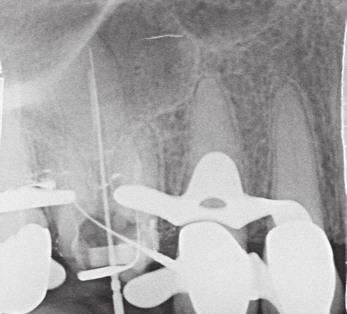 Fall 2 Bei der 46-jährigen weiblichen Patientin war eine prothetische Neuversorgung an Zahn 16 geplant.