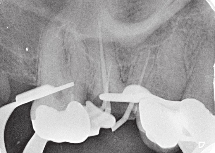 8), dieser wurde mit einer Hartmetallfräse analog der Wurzelanatomie in drei Teile separiert, welche dann vorsichtig mit einem Ultraschallansatz (ACTEON) gelockert und aus dem Zahn entfernt werden