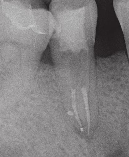1980er Jahren durchgeführt wurden. Patientenfall 1 Der 56-jährige Patient stellte sich mit einer defekten Kompositfüllung an Zahn 45 vor.
