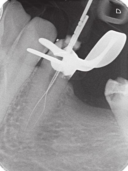 Unter Dentalmikroskop wurde vorsichtig mittels zu Trepanbohrern gekürzten Gates-Glidden-Bohrern (VDW) der koronale Kanalanteil erweitert, sodass der zweite bukkale Kanal sicht- und mit einem