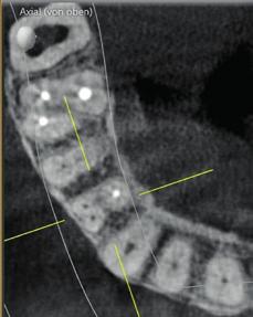Micro-Opener 08.04 (Dentsply Sirona) sondieren ließ (Abb. 19). Nach Katheterisierung und endome trischer Längenüberprüfung wurde eine Röntgen messaufnahme aller drei Kanäle angefertigt (Abb. 20).