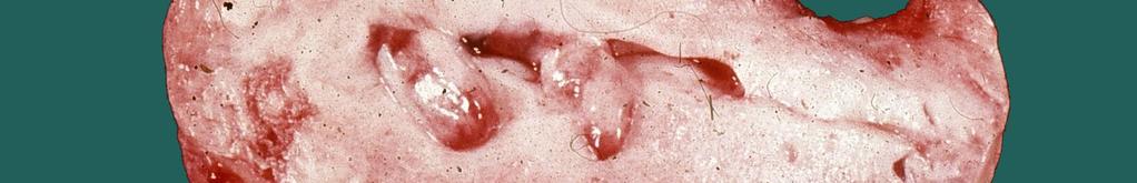 arbeiteten in ihrer Studie anhand von 100 hysterektomierten Uteri heraus, daß die Inzidenz des Uterus myomatosus sogar bei 77% liegt 14. Myome zählen zu den benignen Tumoren des Uterus.