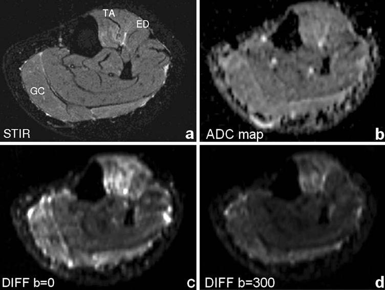 Diffusion-weighted MRI of denervated muscle: a clinical and experimental