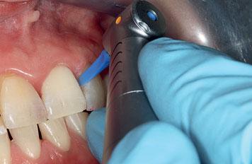 FOKUS Abb. 5 Abb. 6 Abb. 5 Abb. 6 Ein oszillierend schwingender EVA-Kopf (EVA 5000, Fa. Dentatus) mit Kunststoffeinsatz für die Reinigung von schmalen Zahnzwischenräumen. Dieselbe Patientin aus Abb.