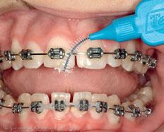 FOKUS Abb. 1 Abb. 2 Abb. 3 Abb. 1 Abb. 2 Abb. 3 IDBs sind vielfältig einsetzbar. Mundhygieneinstruktion mit IDB. Hygienefähiger Zahnersatz ist wichtig. ( Dr. Daniela Hoedke, Abt.