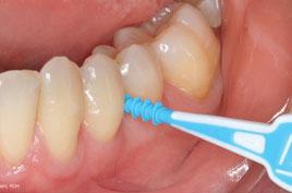 ÜBUNG MACHT DEN MEISTER Da Plaque innerhalb von 24 Stunden reift, sollten Approximalräume täglich gereinigt werden wegen der abrasiven Putzkörper ohne Zahnpasta.