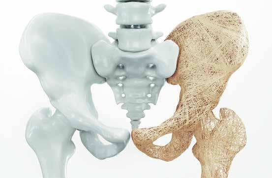 Osteoporosetrainer Die Osteoporose ist die häufigste Knochenerkrankung im höheren Lebensalter. Aber schon ab dem 40. Lebensjahr kann sie vermehrt auftreten.
